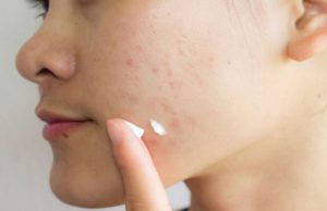 How to treat Acne Scar at Home