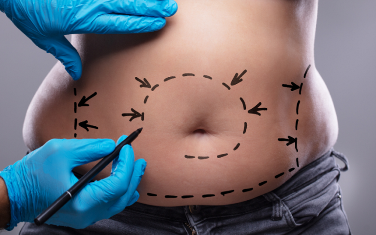 CoolSculpting