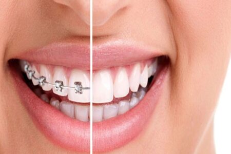 Orthodontic Treatment