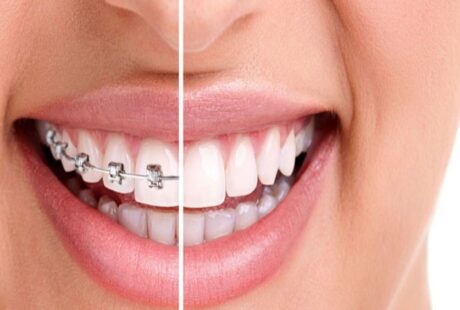 Orthodontic Treatment