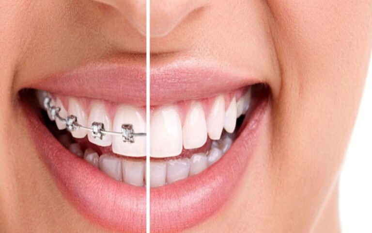 Orthodontic Treatment