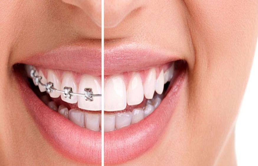 Orthodontic Treatment