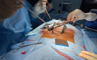 Spinal Surgery